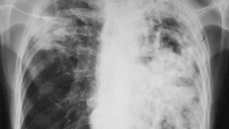 ¿Qué es la melioidosis?