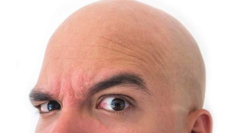 La pastilla que cura la calvicie: este tratamiento experimental te devuelve el pelo en 6 meses