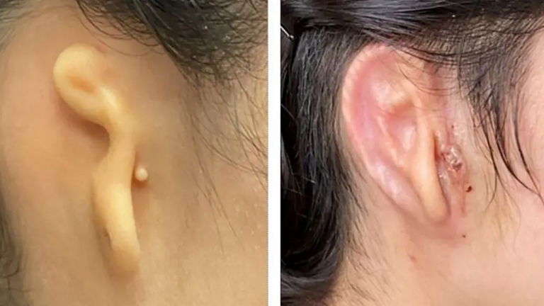 Este trasplante es histórico: una oreja impresa en 3D y hecha con células humanas