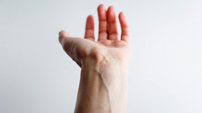 Algunas personas tienen una arteria extra en el brazo, y cada vez son más