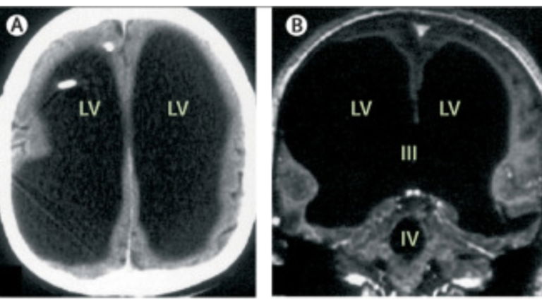 La historia del hombre al que le falta el 90% del cerebro y que vive una vida perfectamente normal